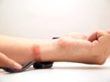 Giải Mã Nguyên Nhân Gây Dị Ứng Khi Đeo Đồng Hồ Thể Thao